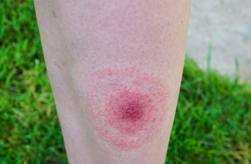 A bullseye rash on a person's skin. (Photo via Getty Images)