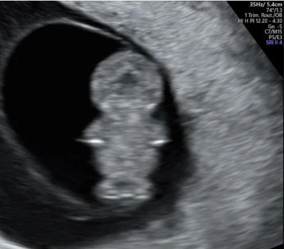 Ultrasound image showing a developing human fetus. Medical details and measurements are visible at the top of the image